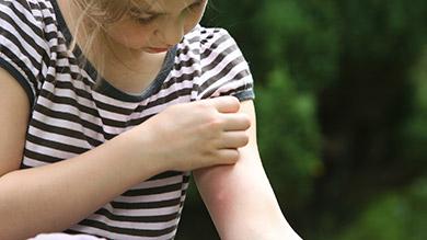 Résultat de recherche d'images pour "piqûres d'insectes"