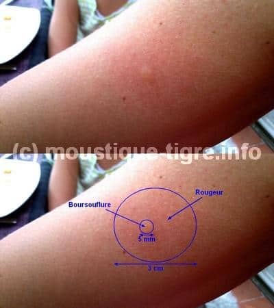 Symptômes piqûre de moustique tigre